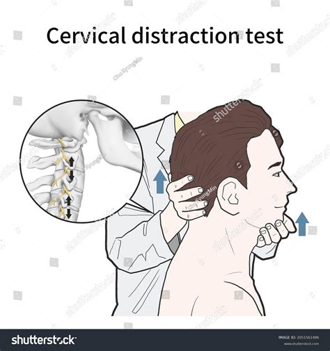 positive cervical distraction test